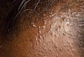 Inflammation